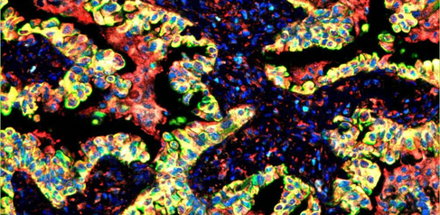 Human lung cancer tissue labelled with cellular markers.