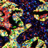 Human lung cancer tissue labelled with cellular markers.