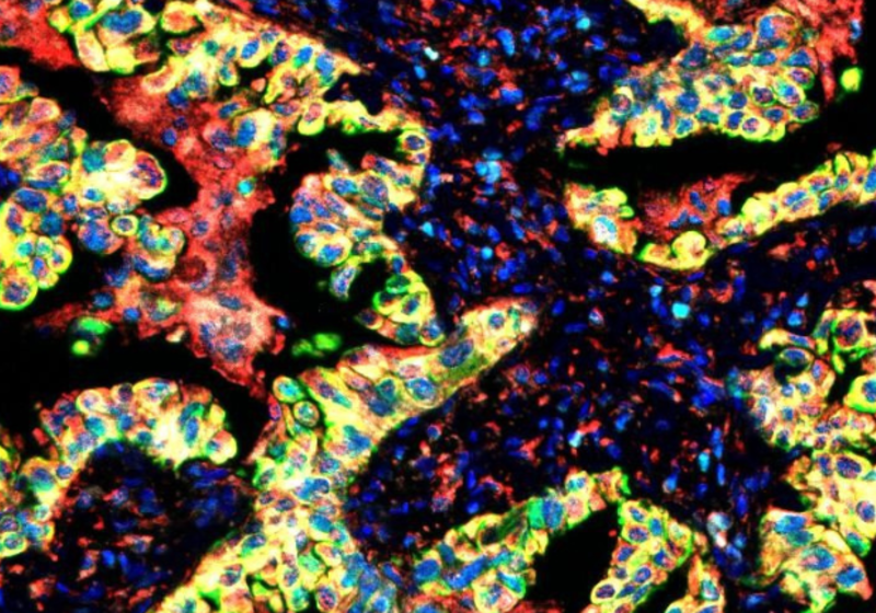 Human lung cancer tissue labelled with cellular markers.